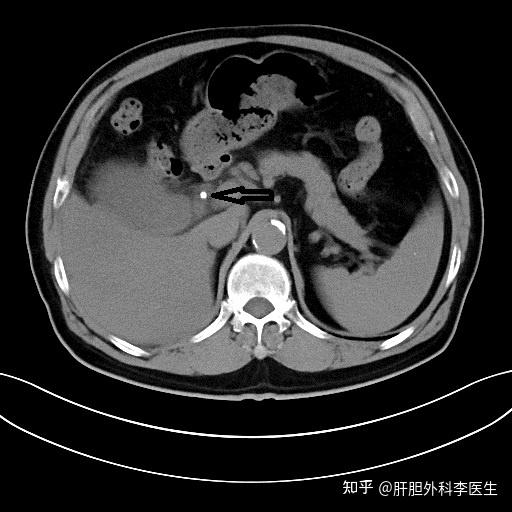 看了一下ct片子,发现胆囊管结石,卡在胆囊管.