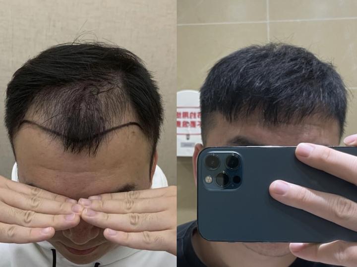 植发4年，聊聊植发的骗局、我植发过程中遇到的坑，以及医院医生选择上的一些方法！ - 知乎