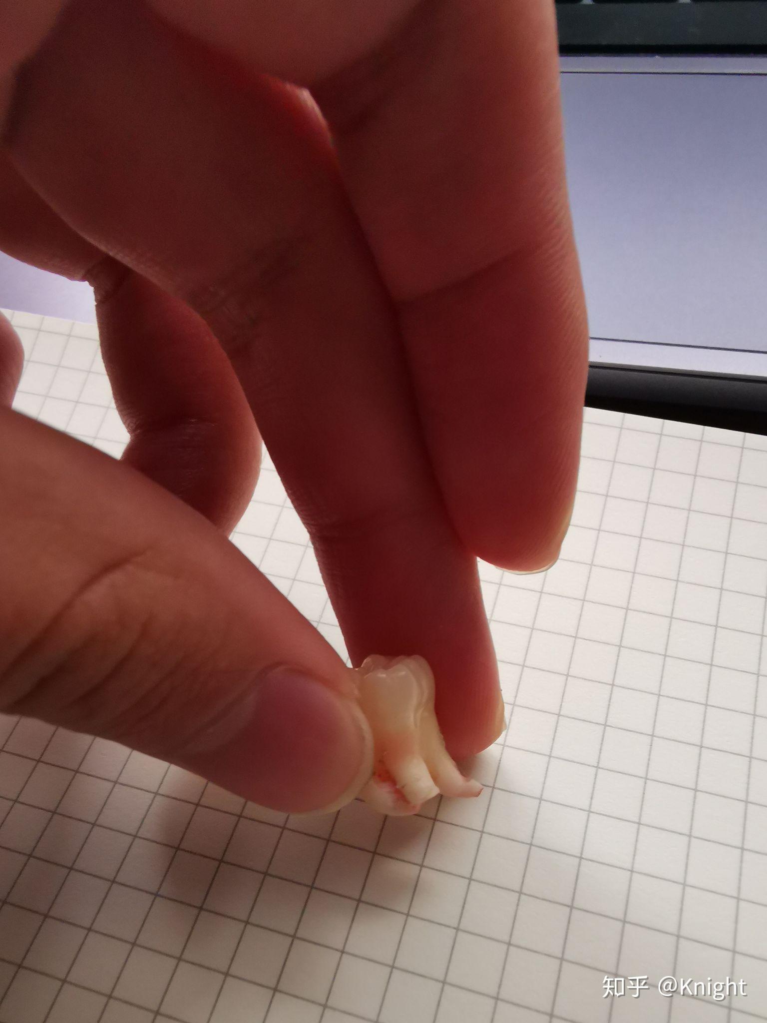 智齿牙根弯曲成鱼钩状能不能拔