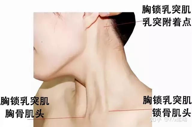 胸锁乳突肌劳损怎么办? - 知乎
