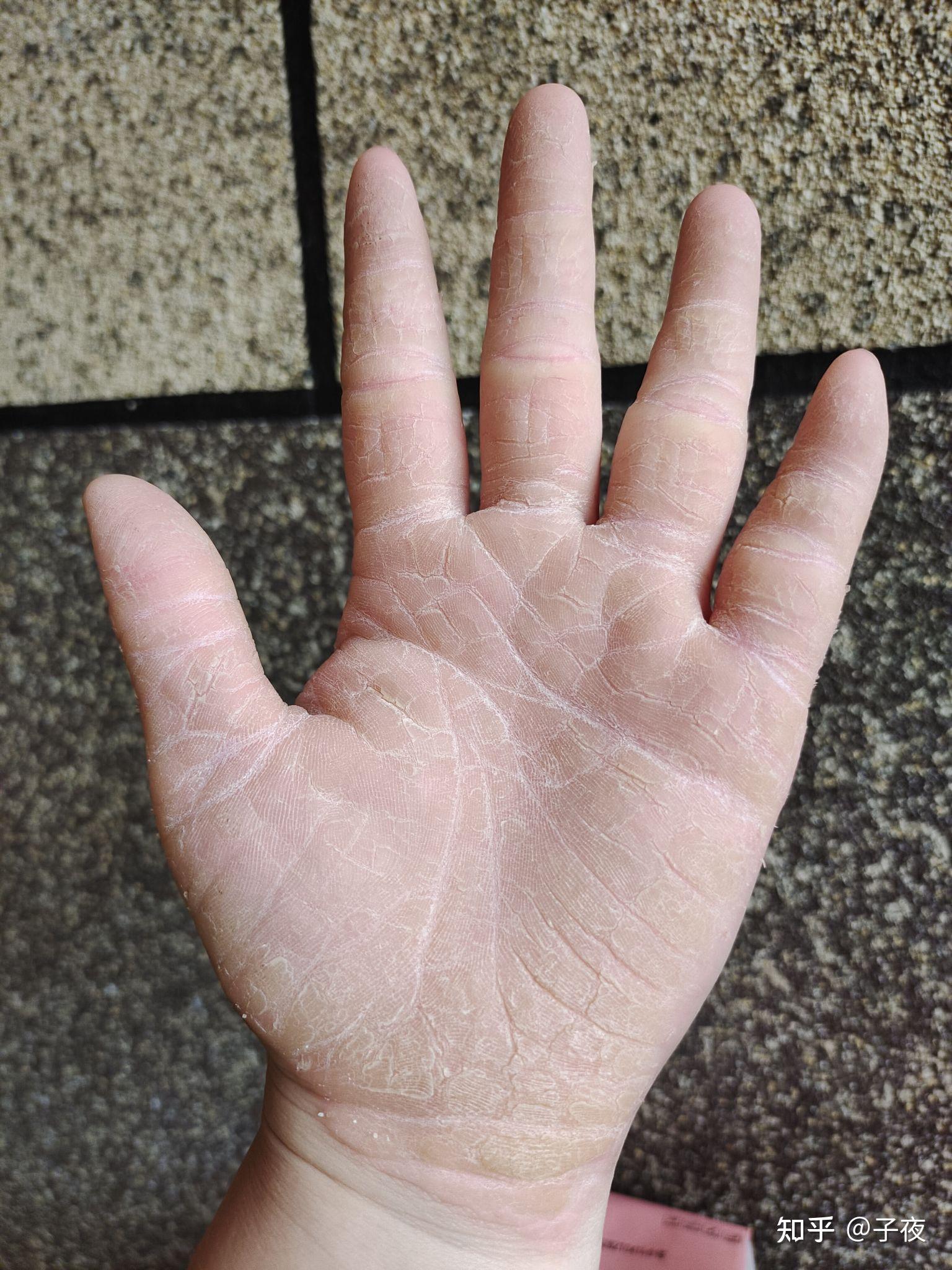 手掌皮肤角化症图片图片