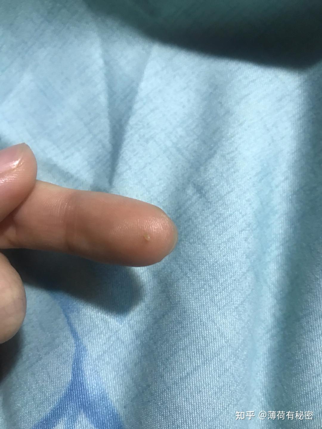 请问痘痘里面挤出来的黄黄的小颗粒是什么东西啊 怎么可以去除?