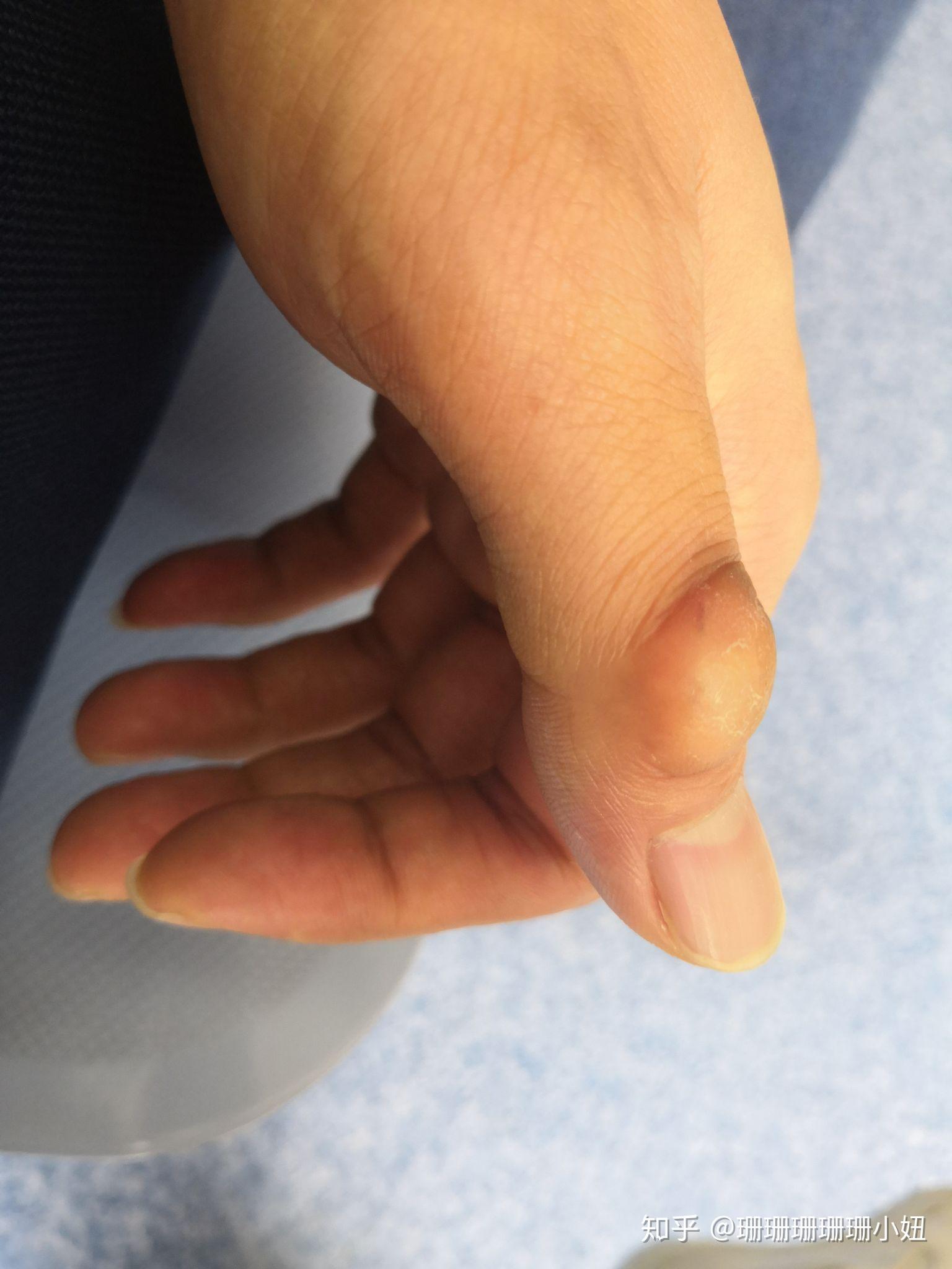 手部关节指垫怎么治疗?