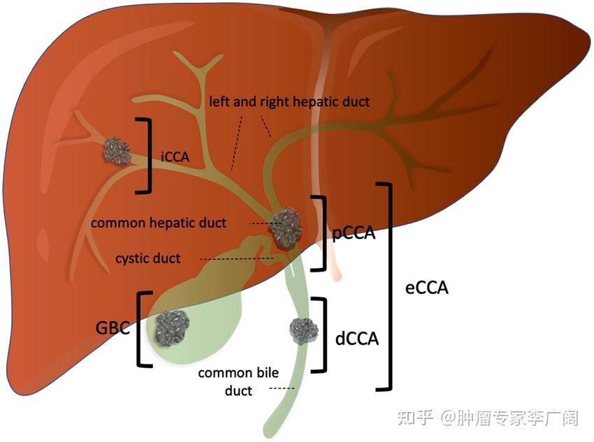 光动力治疗胆管癌，除了其化学消融作用，还有哪些有益作用，机理是什么？ - 知乎