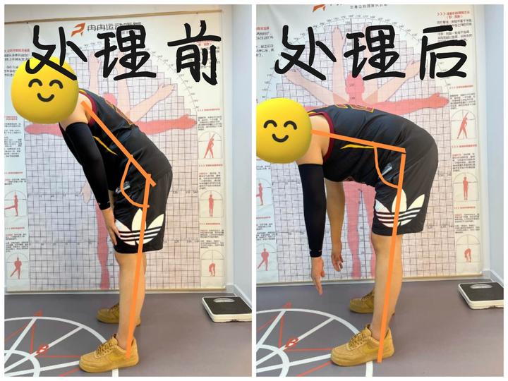 案例分享:弯腰受限 - 知乎