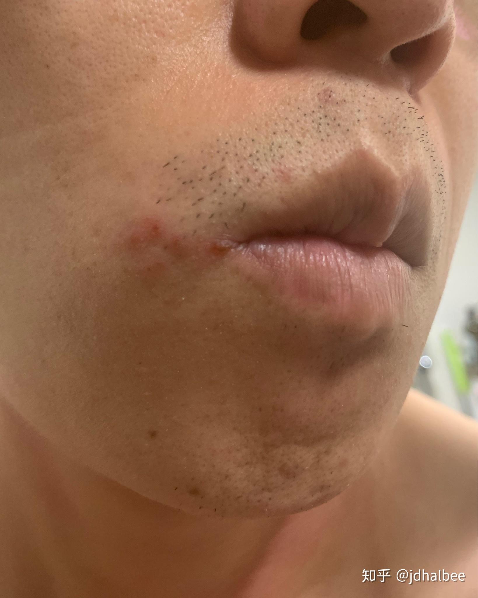 口唇疱疹怎么能快速好啊急