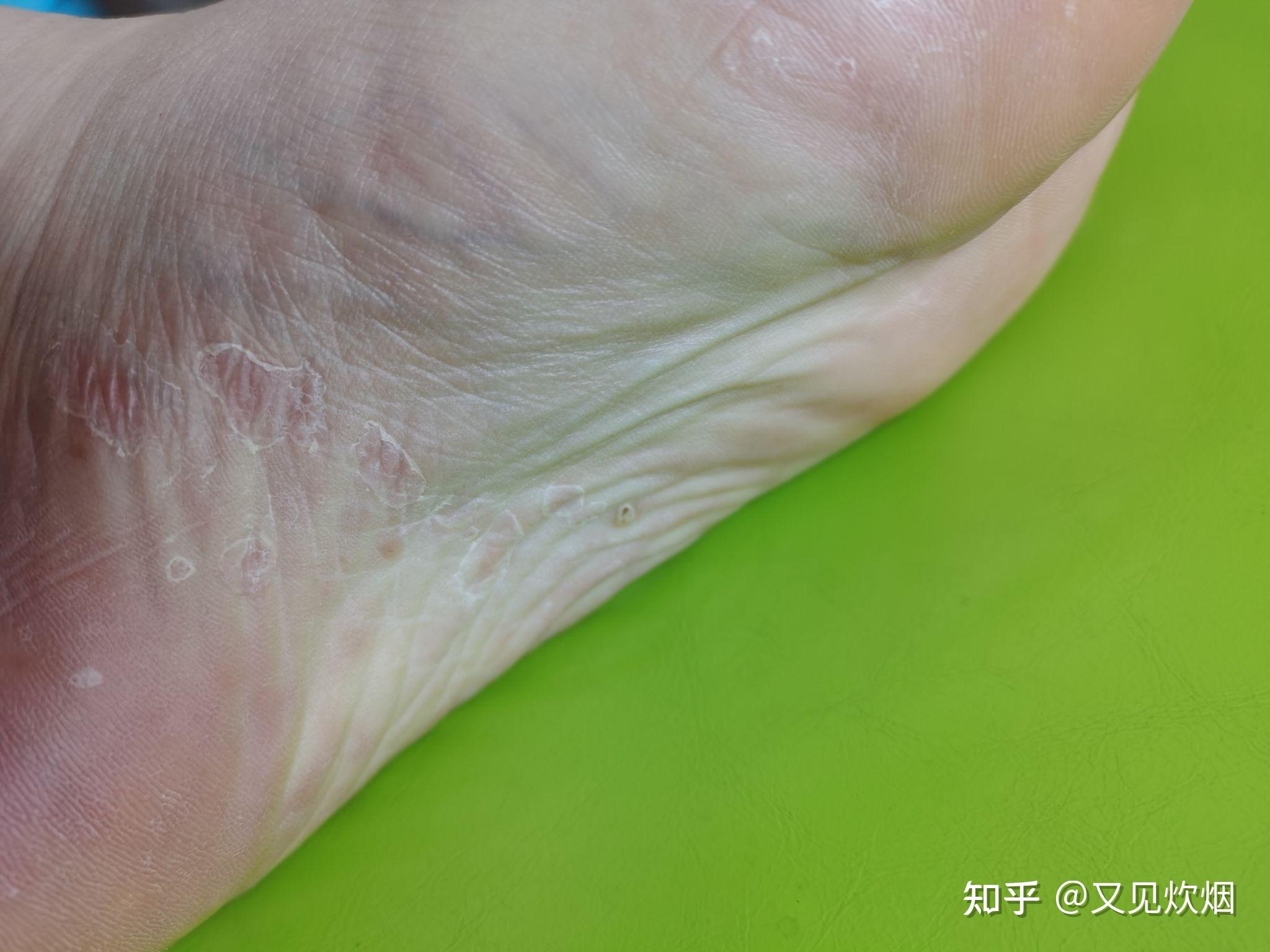 水疱型脚气水泡能扎破吗