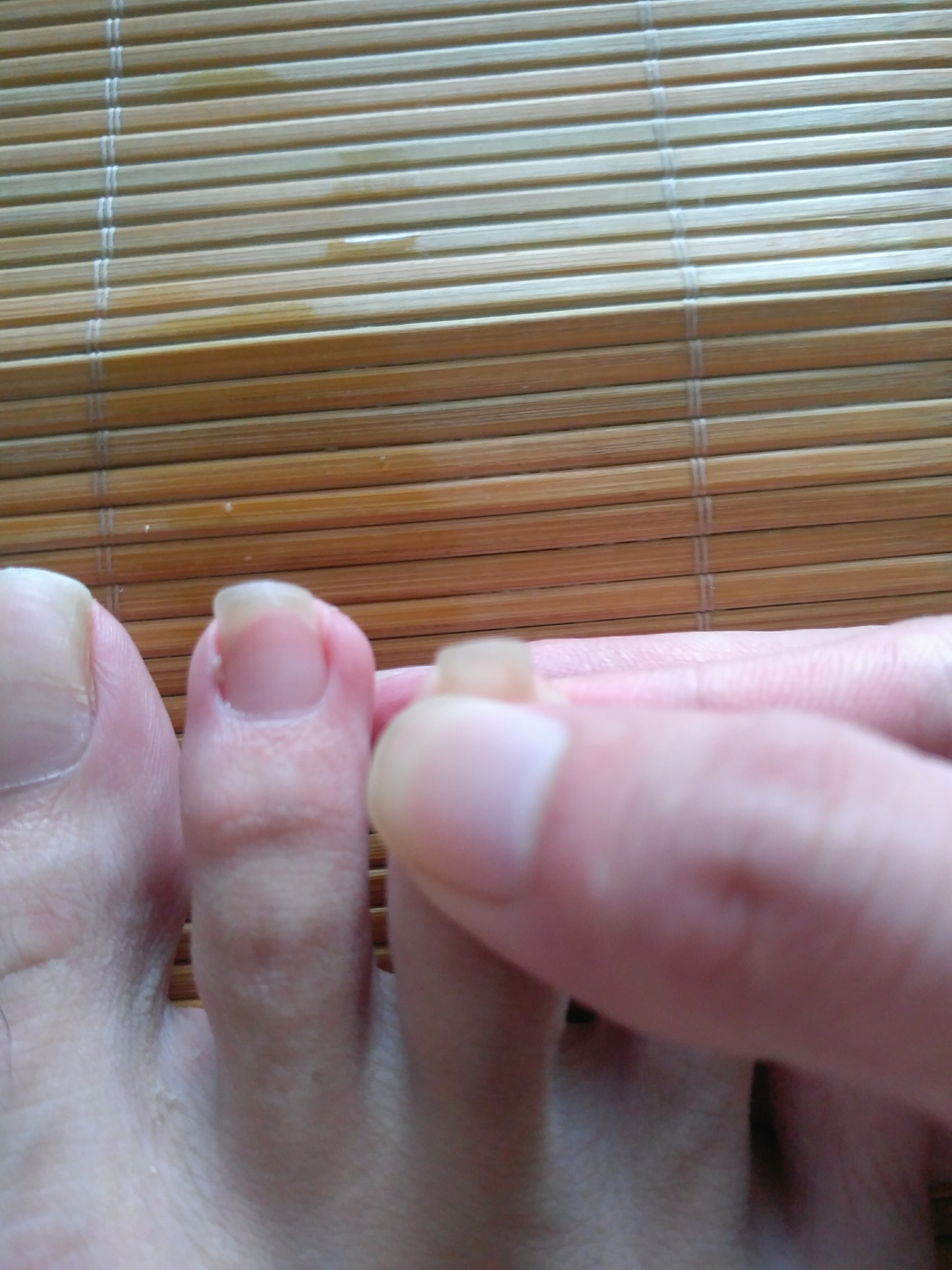 脚指甲长肉里了如何解决