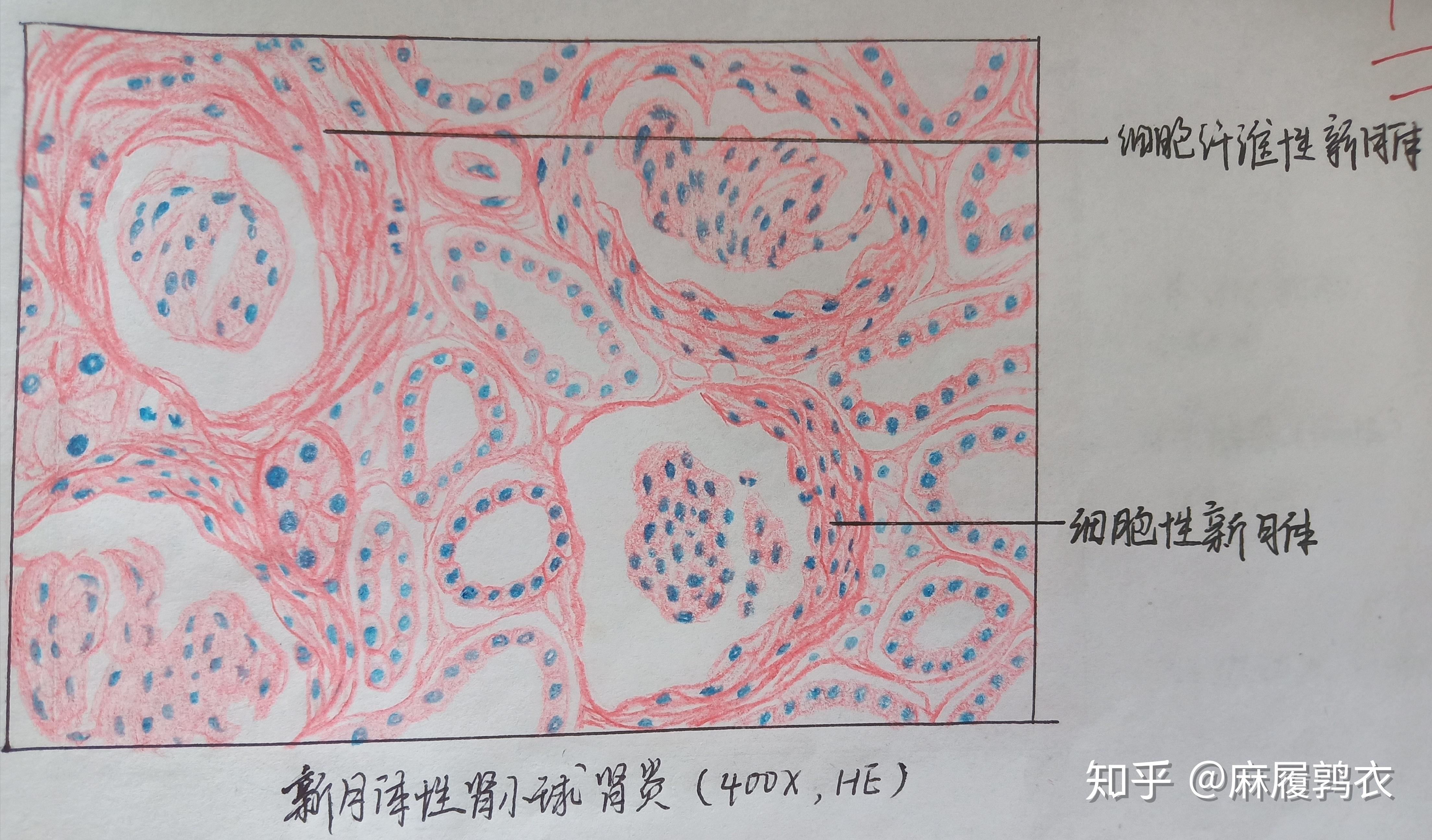 为什么咱们不弄个病理红蓝手绘图的问题呢? - 知乎