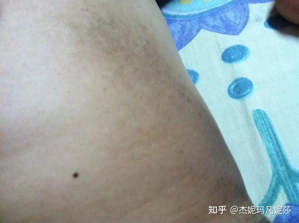 大腿根黑怎么办? - 知乎