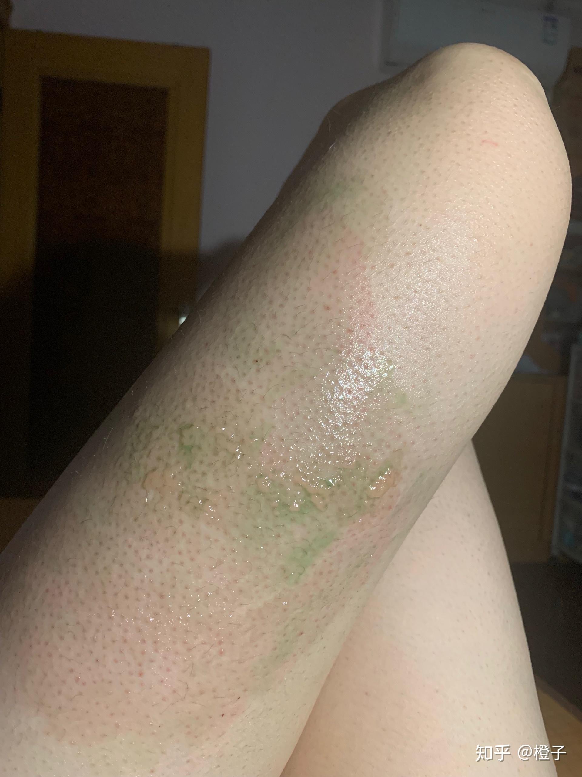 烫伤前后皮肤的具体变化是怎样的