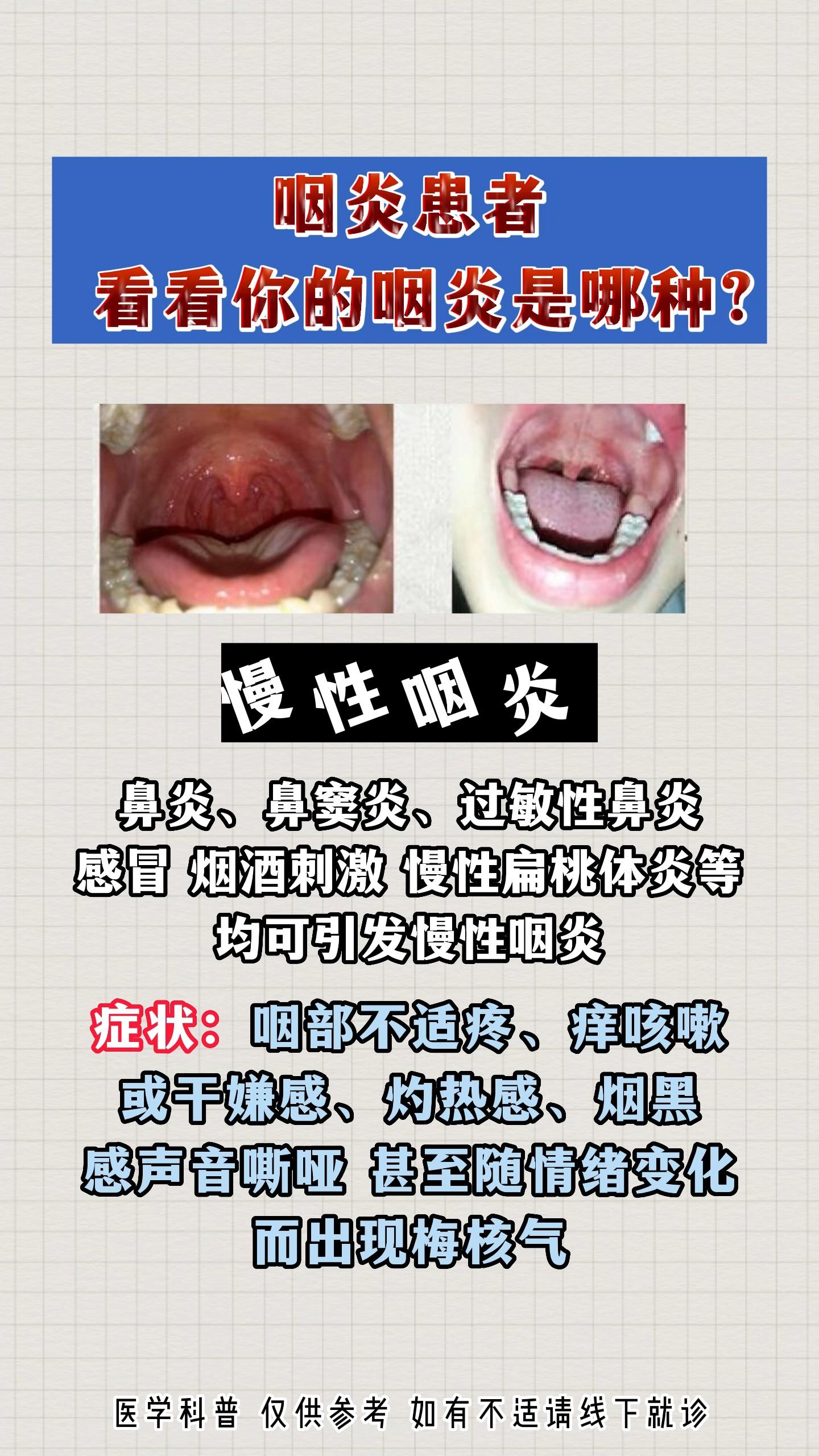 慢性咽炎患者,看看你的咽炎是哪种?