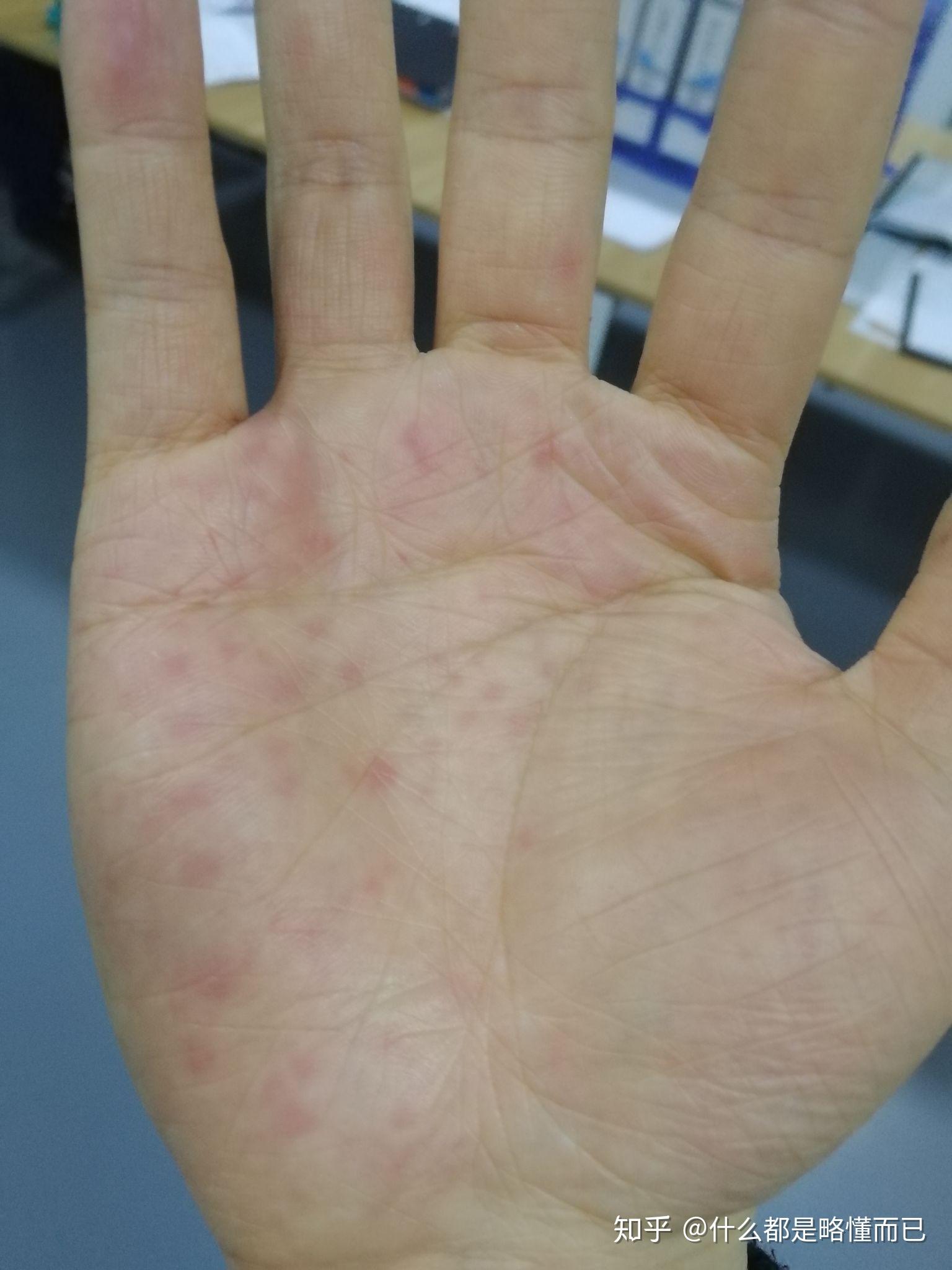 手掌出汗严重,死皮,长了好多红点,有的时候很痒,药店的人说是湿疹