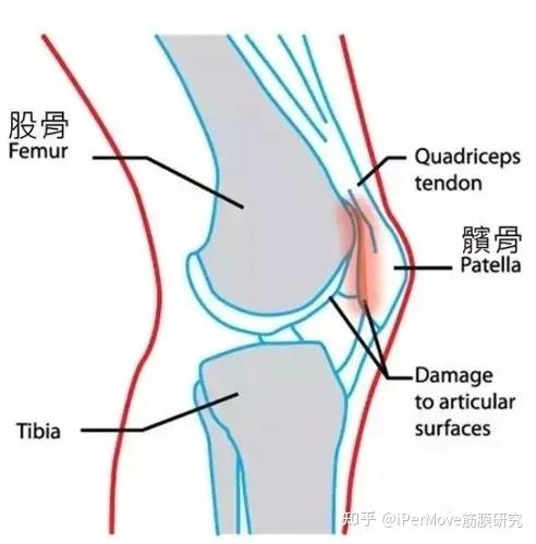 髌骨疼痛是什么原因图片