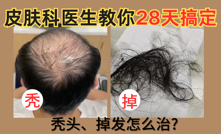 【男士秃头秃顶必看】掉发严重怎么办？秃头秃顶还有救么？【皮肤科医生】总结的男士秃头秃顶自救指南请查收，28天养出浓密秀发，秃头秃顶看这篇就够了 ...