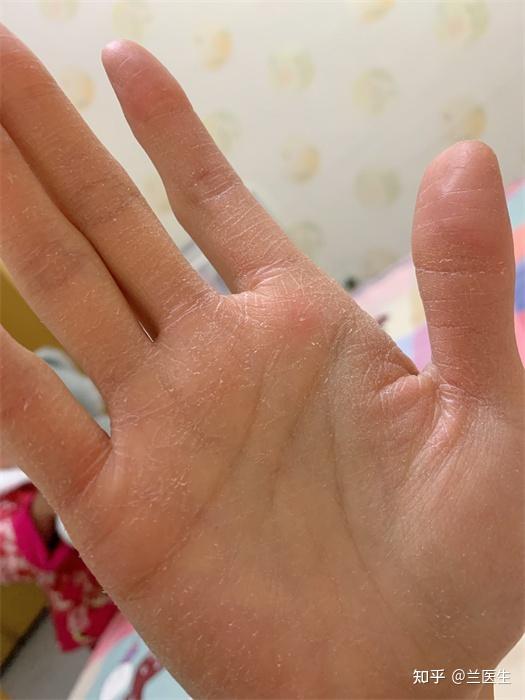 母亲是做快递行业的本身皮肤就干燥冬天双手就一层层蜕皮指甲处开裂口