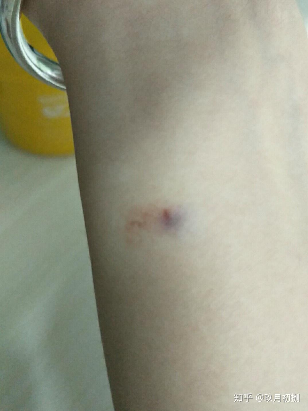 结核皮试出现如下状况是啥结果呢