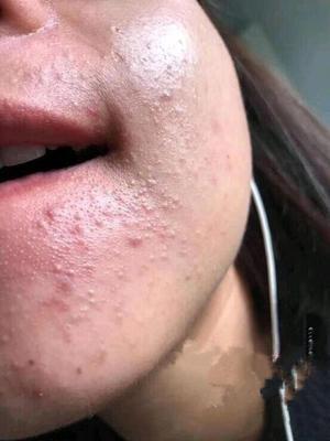 面部出现毛囊炎疙瘩还能化妆吗?