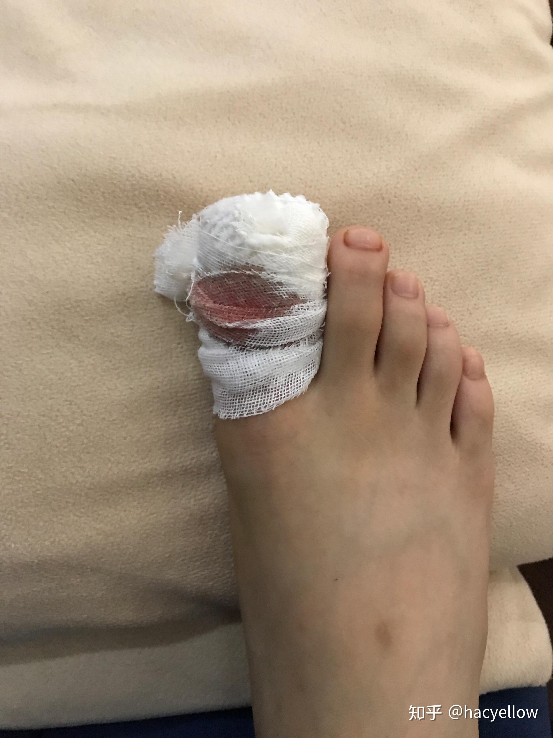 甲沟炎拔甲是怎样的体验