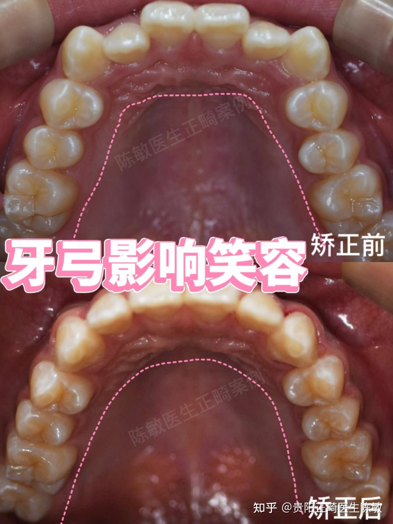 正常牙弓形状图片图片