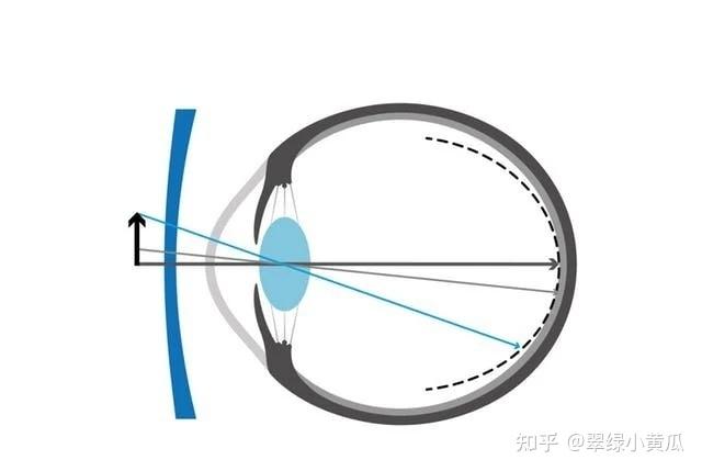 离焦镜片真的有用吗? - 知乎