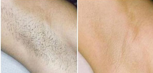 女生腋下黑怎么改善?有办法淡化黑色素吗? - 知乎