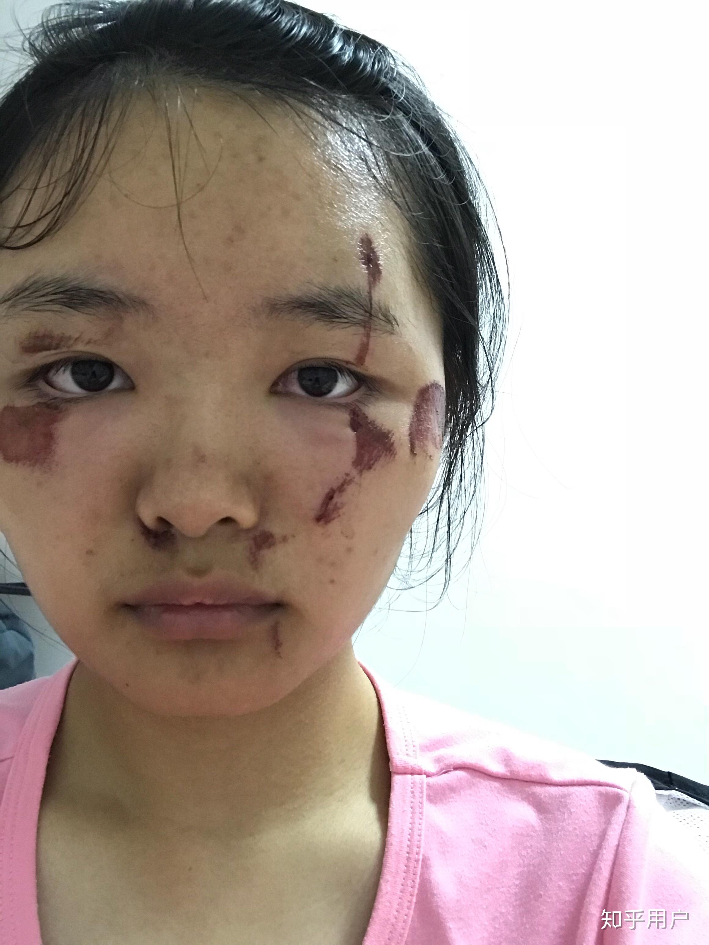 脸部大面积擦伤伤口较深要注意什么