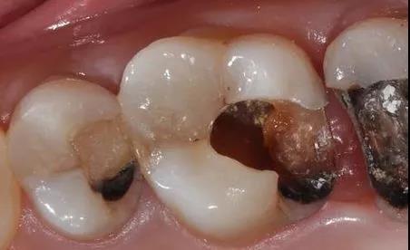 哪些情况需要杀牙神经