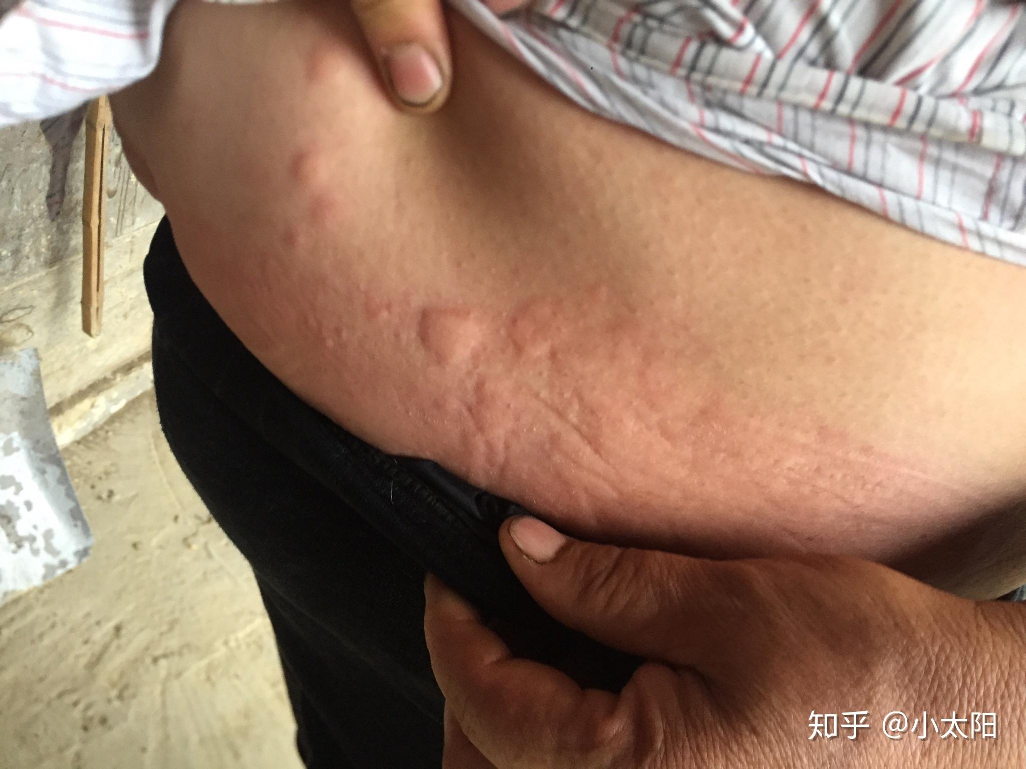 这是不是过敏性荨麻疹有照片