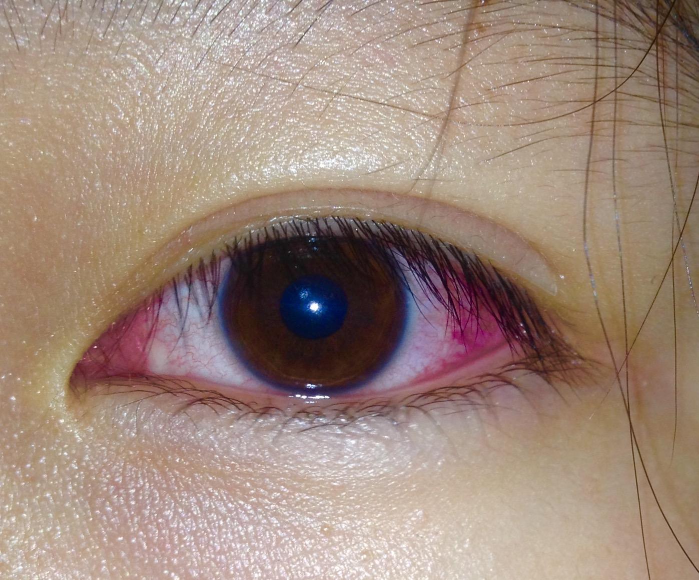 大家有没有得过或者发现红眼病患者眼睛什么样?