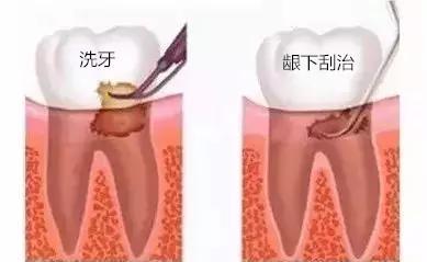 洗牙和牙周刮治有什么区别