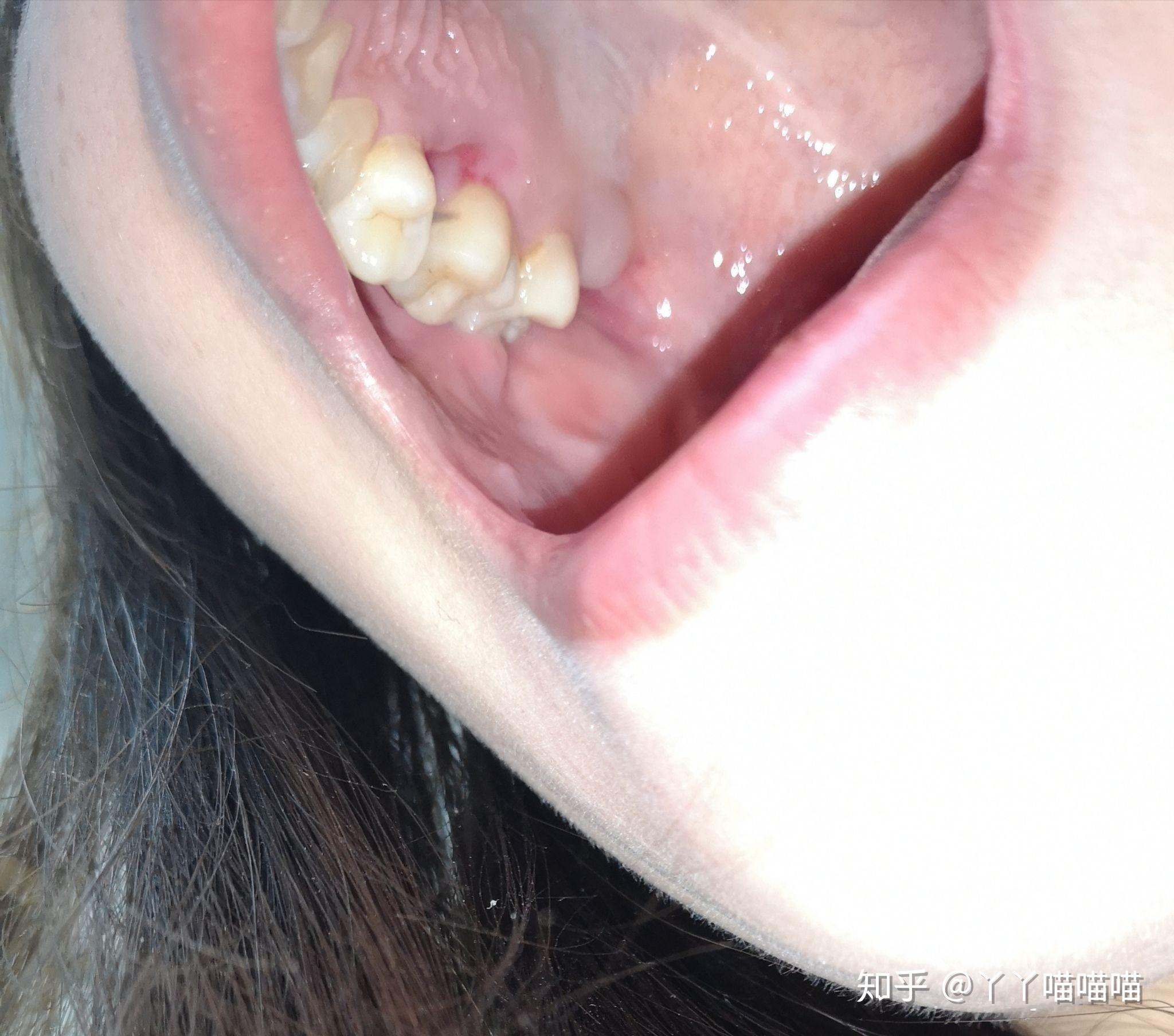 拔牙后恢复过程全解? - 知乎