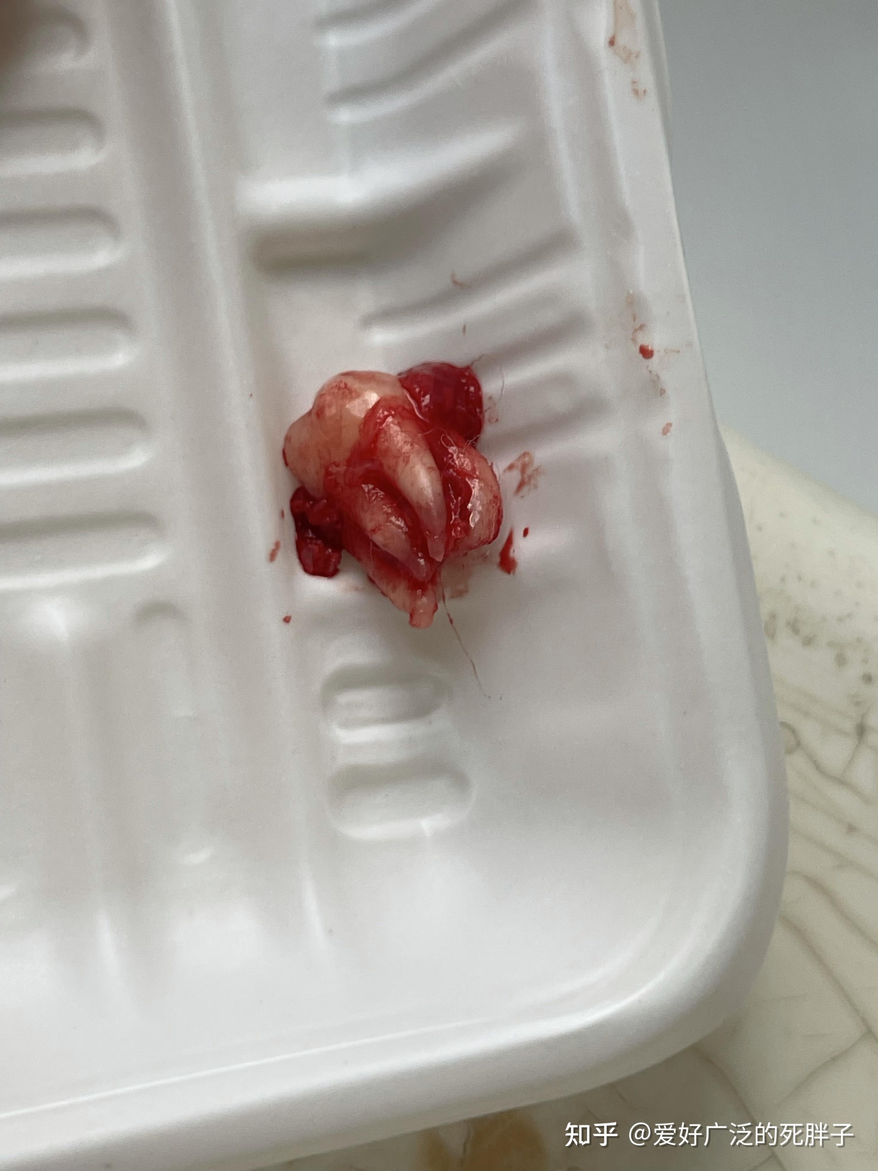 你见过最奇怪的智齿,是什么样子的?