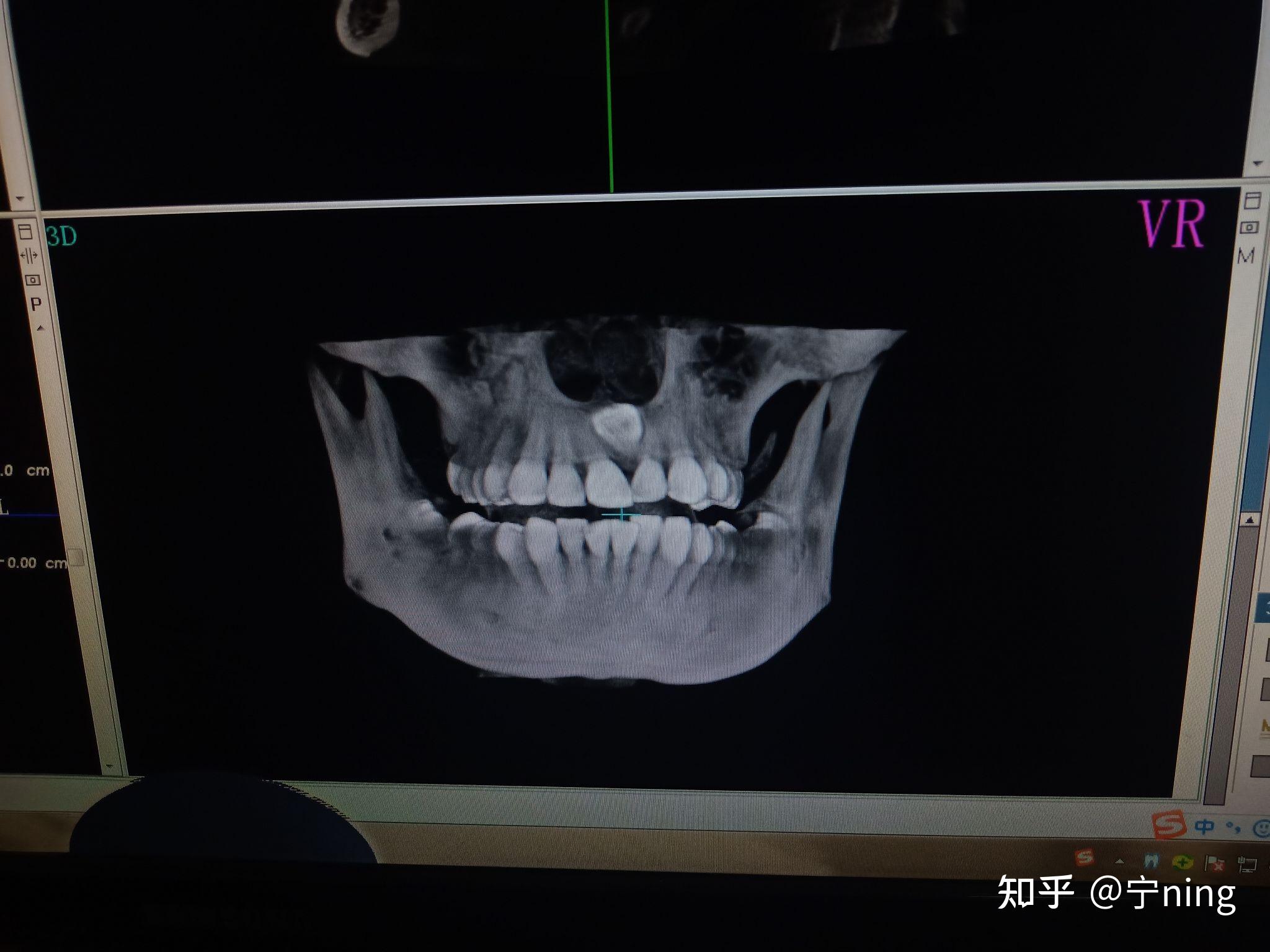 倒着长的智齿是什么样的? - 知乎