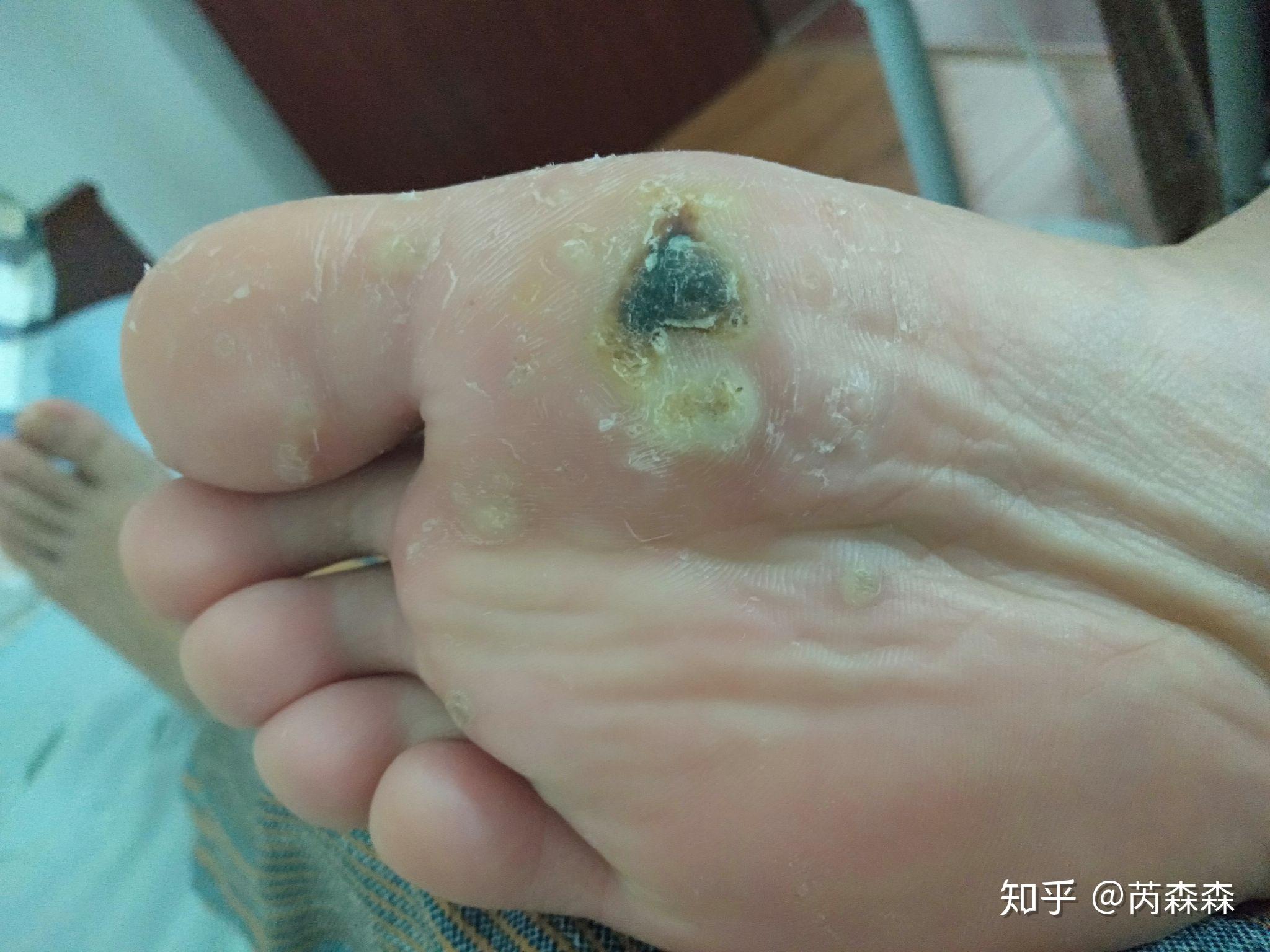 脚上感染长了疣怎么弄