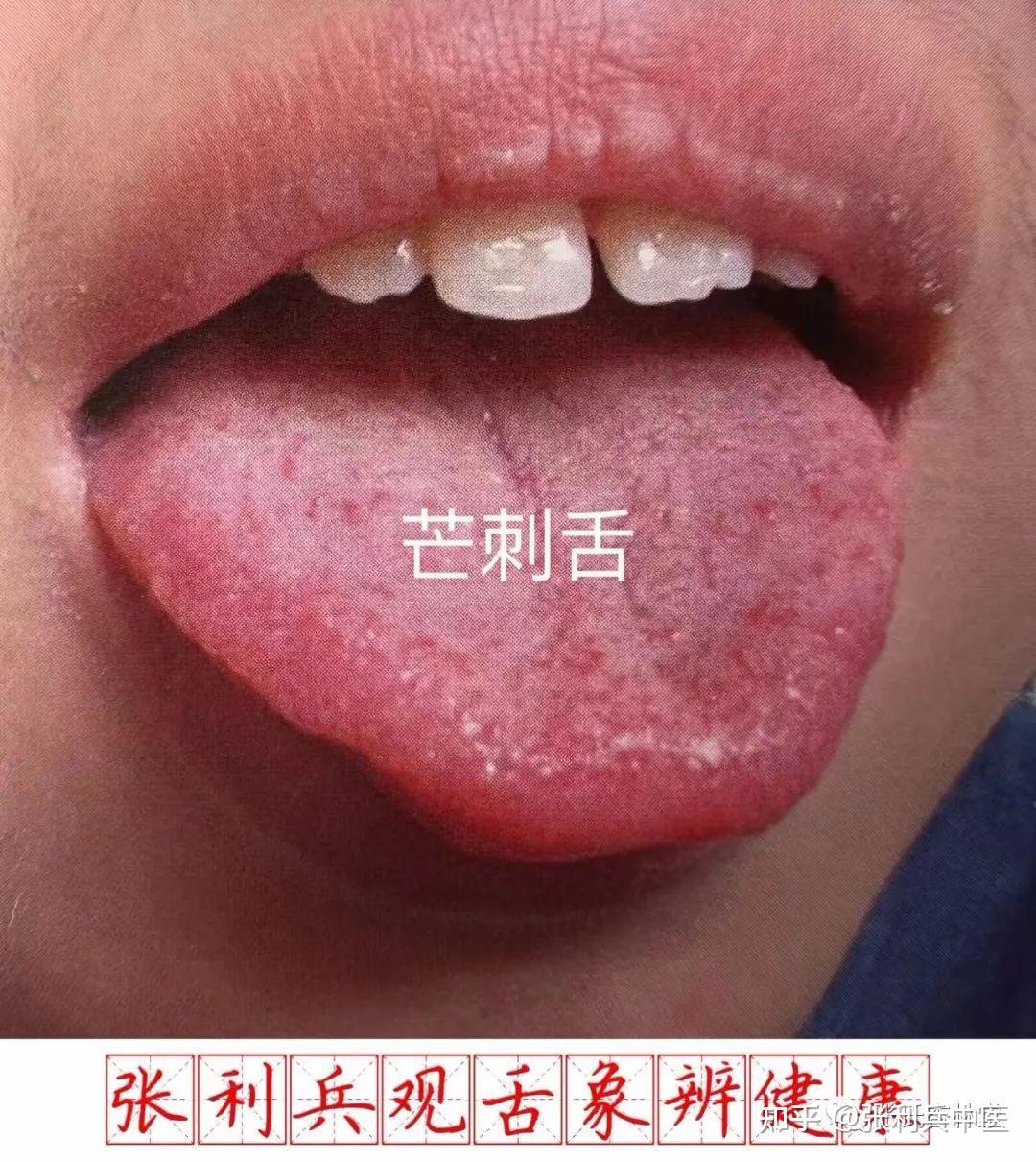 张利兵:“观舌象辨健康”第19讲--舌形辨证诊病之芒刺舌 - 知乎