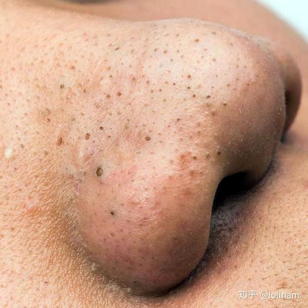 黑头会越来越大吗