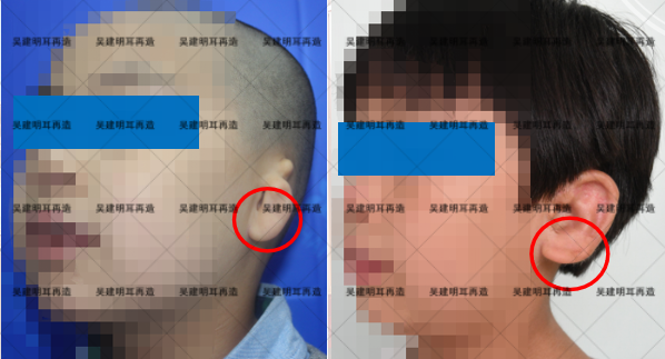 耳再造手术中,残耳需要切除吗? - 知乎