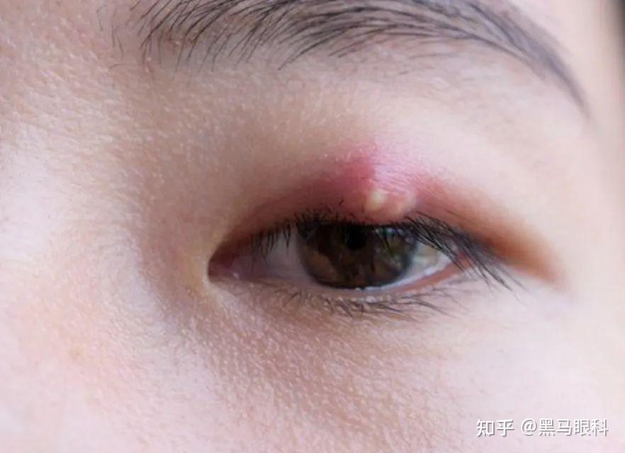 又双叒叕长了麦粒肿？ 眼科大夫教你一次搞定 - 知乎