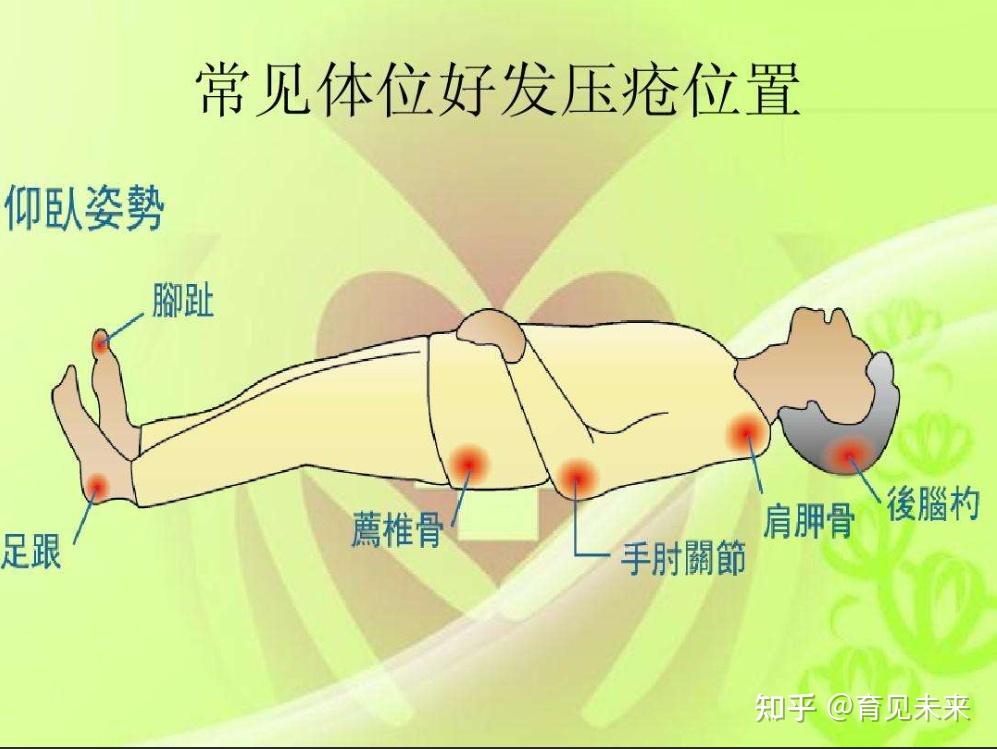 压疮的危害及治疗方法 - 知乎