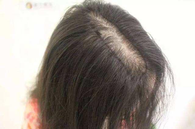 女生发缝变宽,三个穴位帮你缓解症状【广州肤康】 - 知乎