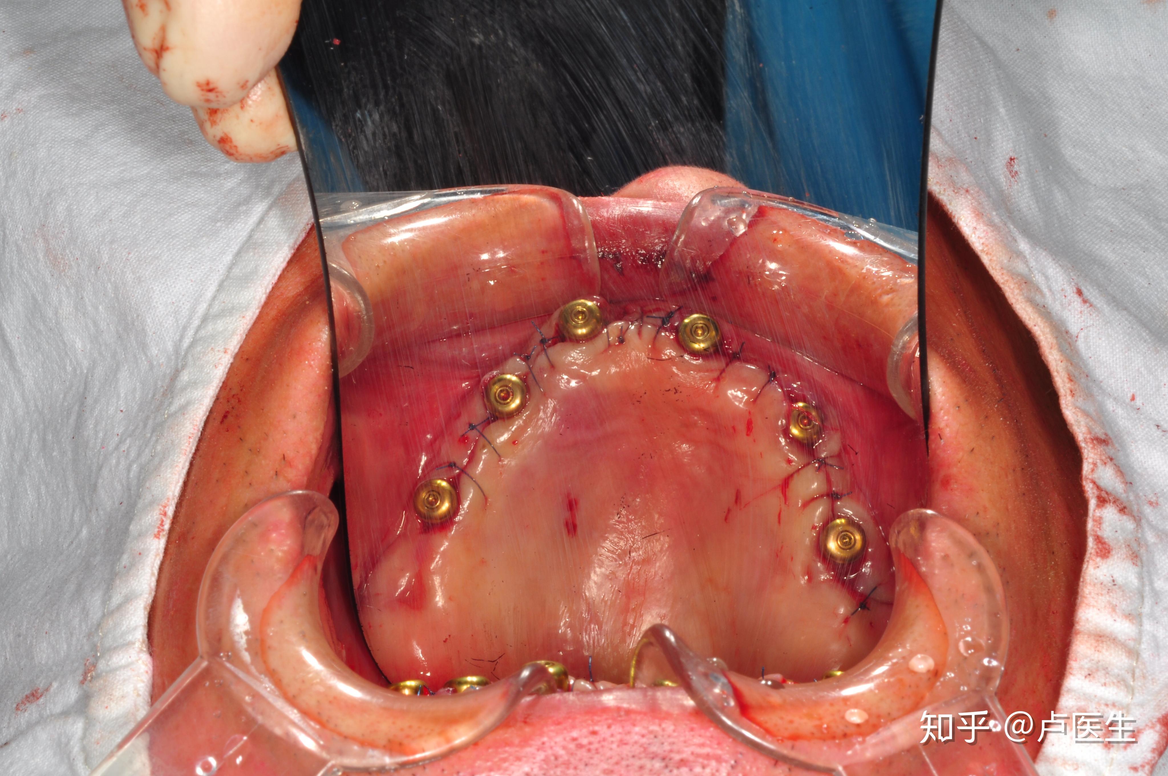 什麼是all on 4全口種植牙技術? - 知乎