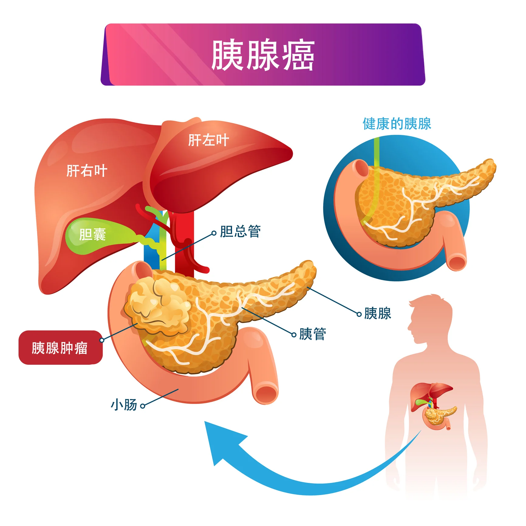 胰腺瘤一般能活多久？ - 知乎