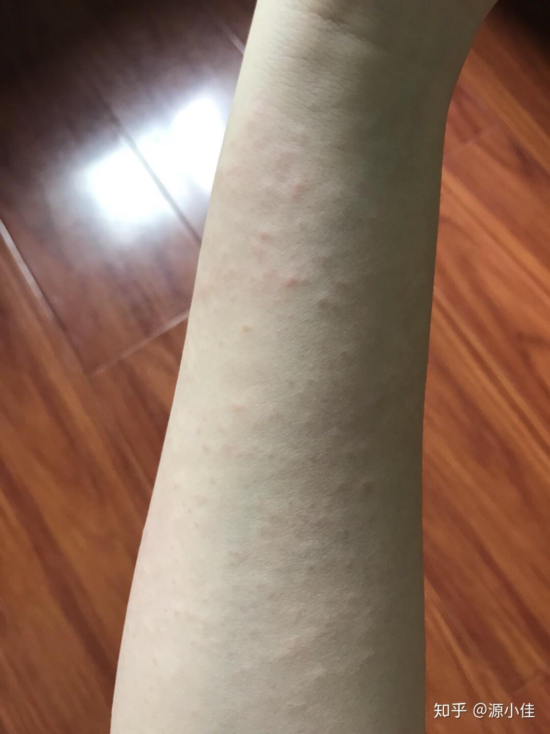 食物过敏为什么反应在面部皮肤上