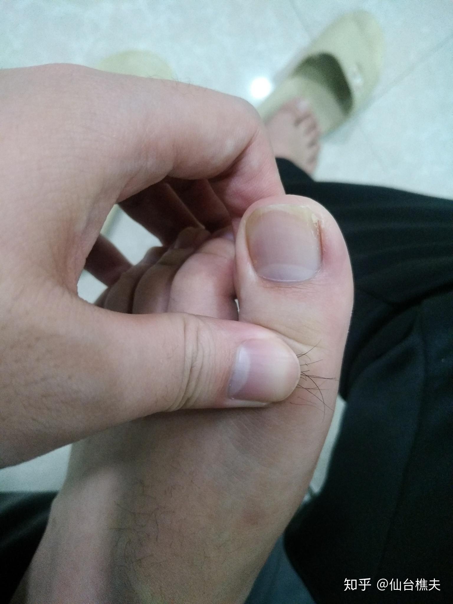 大脚趾甲有一条特别深的横纹,看起来跟裂开了一样,想请教一下这是怎么