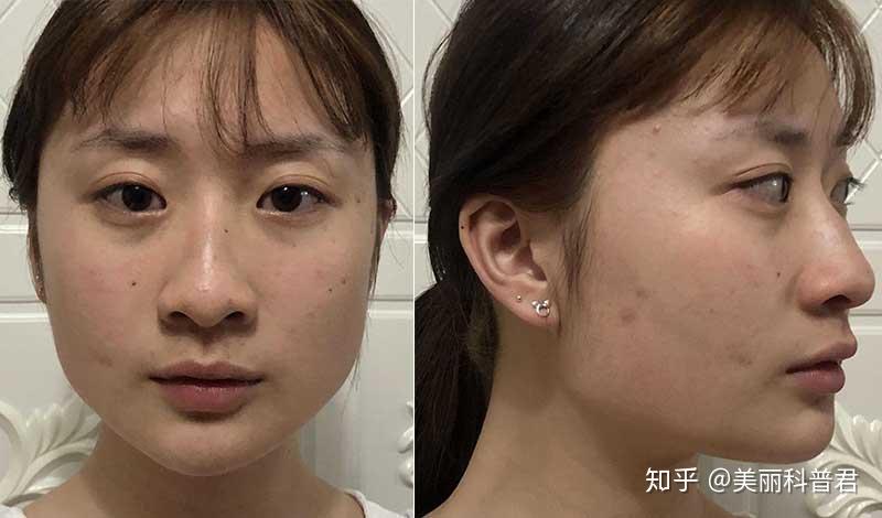 因为方脸 脸宽 下颌骨肥大而自卑怎么办 该不该削骨? - 知乎