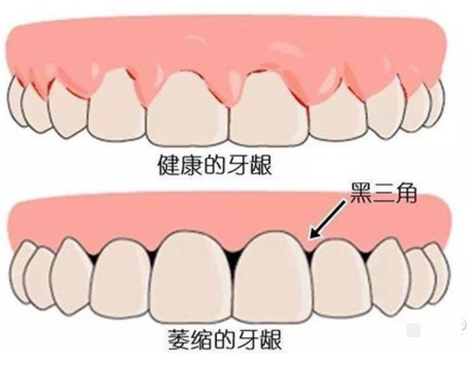 牙齿矫正导致牙龈萎缩怎么办?牙齿矫正期间有什么注意事项?如何做好口腔清洁? - 知乎