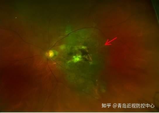 老年性黄斑变性，定期治疗是关键 - 知乎
