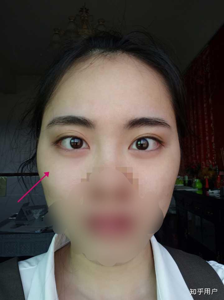 眼睛高低不对称怎么办