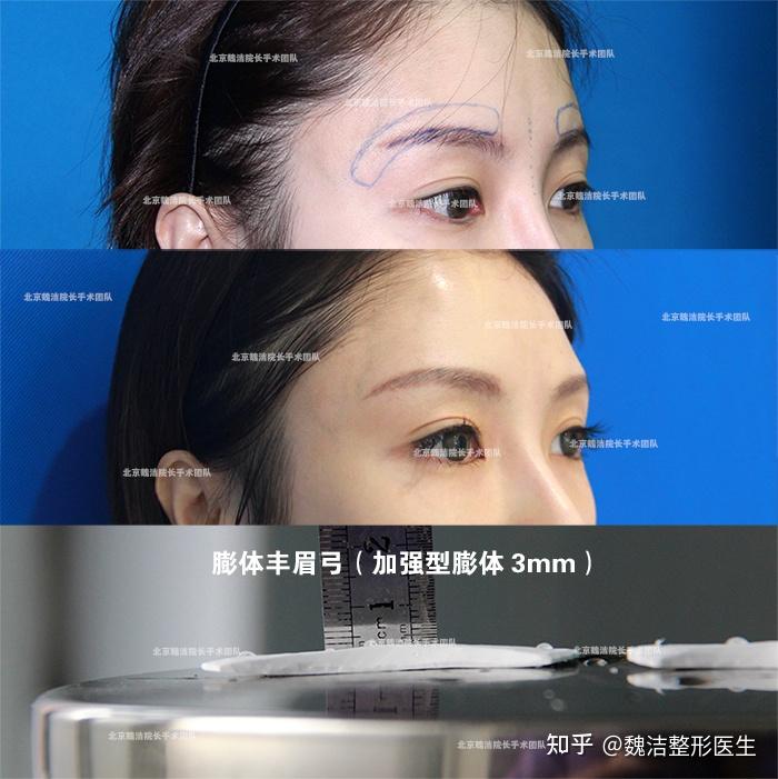 假体丰眉弓会改变眉眼间距么?垫高眉弓眼尾会有提升的感觉么? - 知乎